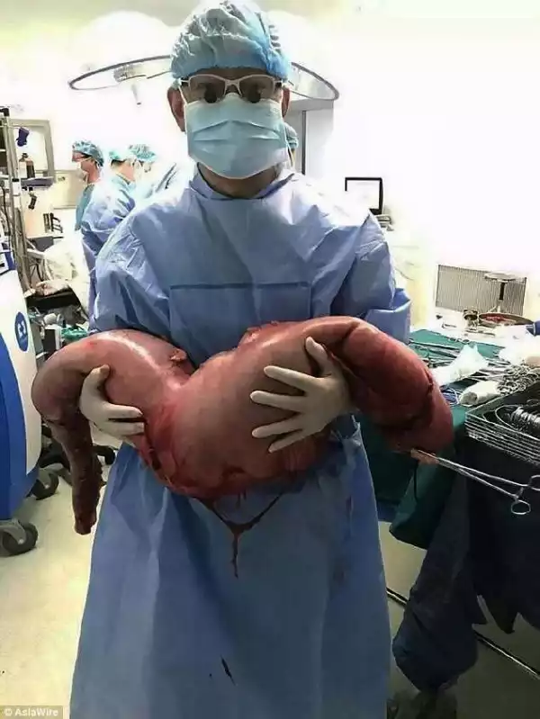 Chinese Doctors Remove 13Kg Of Stuck Poo From Man’s Bowel After 22 Years Viewers’ Discretion